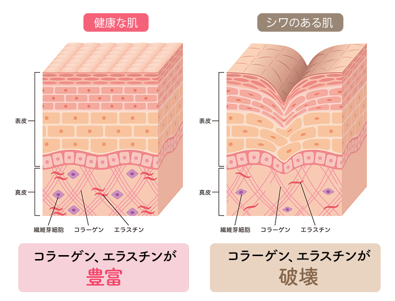 健康な肌の方はコラーゲン、エラスチンが豊富。シワのある肌はコラーゲン、エラスチンが破壊